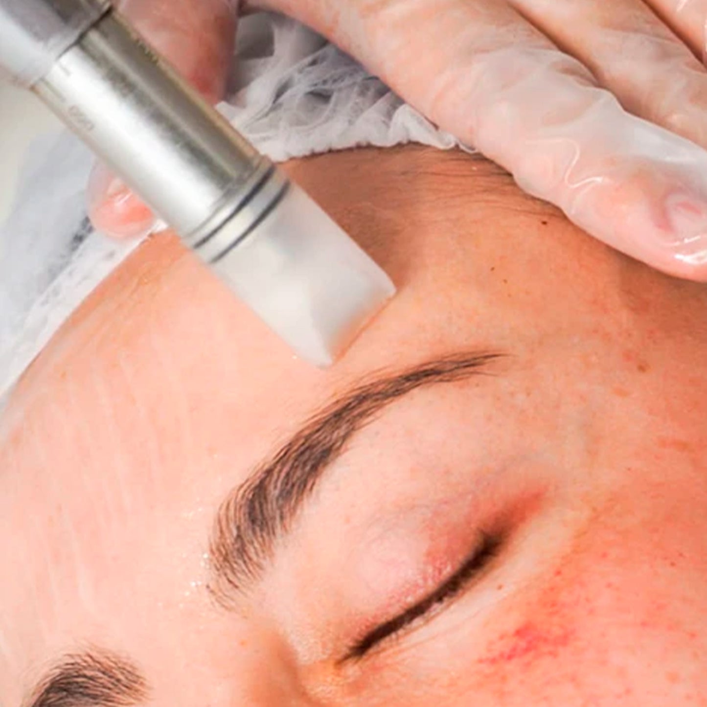 Micropunción Despigmentante de Precisión (60 min)