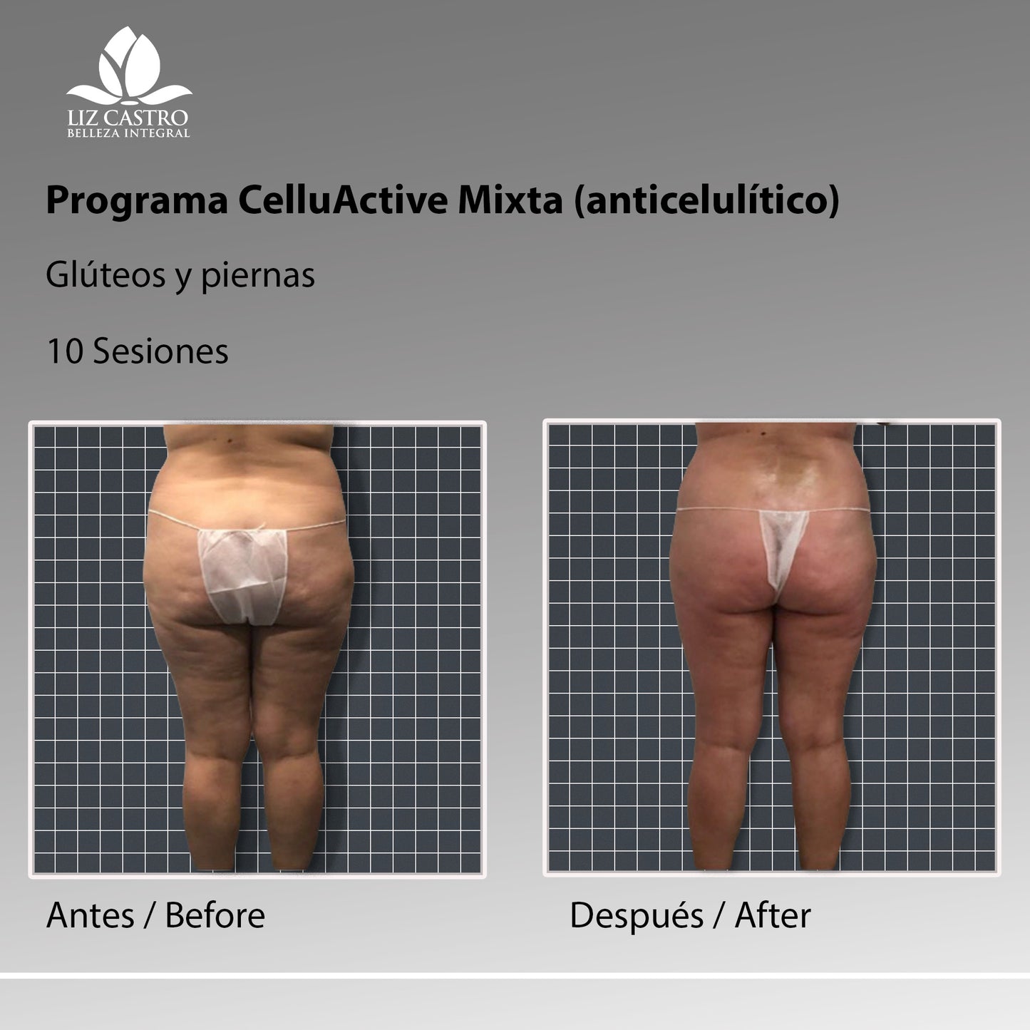 Programa anticelulítico para celulitis blanda