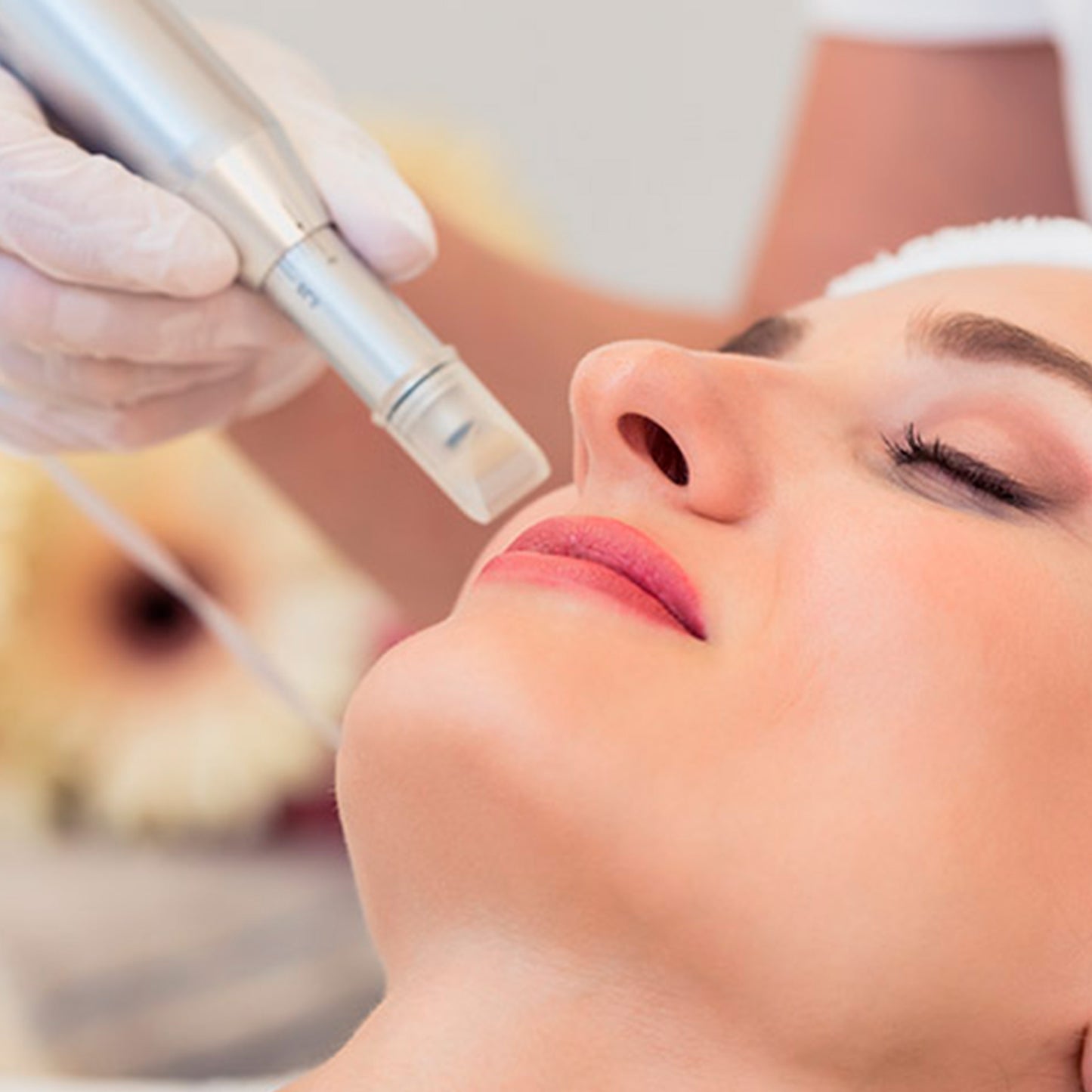 Nanopore TXA Bright (micropunción despigmentante)