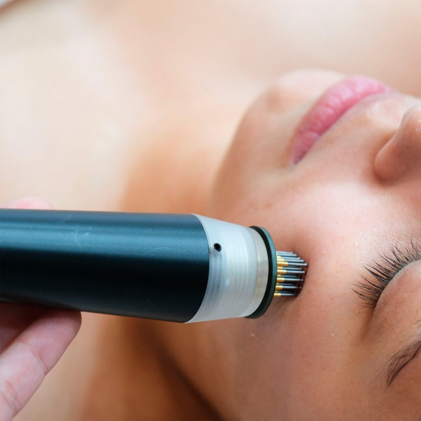 RF Fraccionada Pulsada Imperium (cicatrices post-acné)