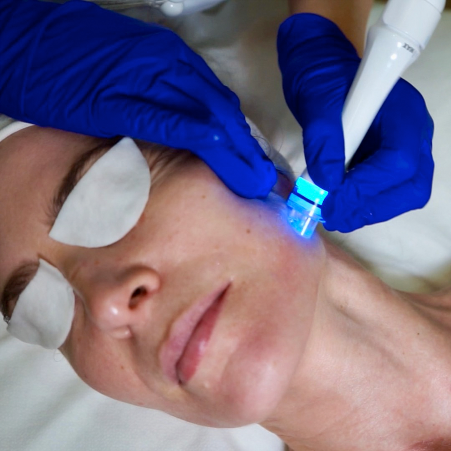 Aquapure (Hidrodermoabrasión)