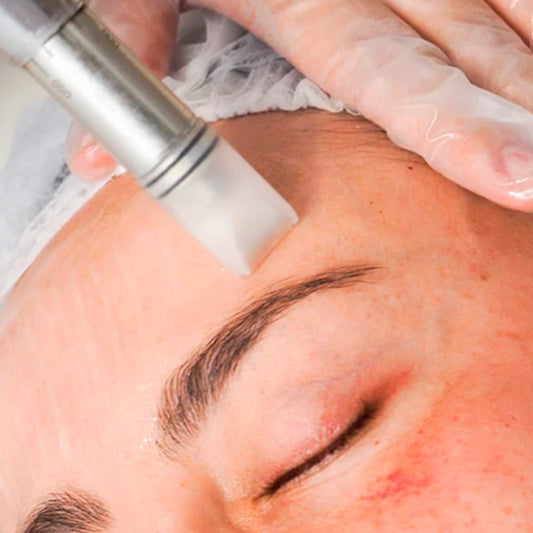 Micropunción Despigmentante de Precisión (60 min)