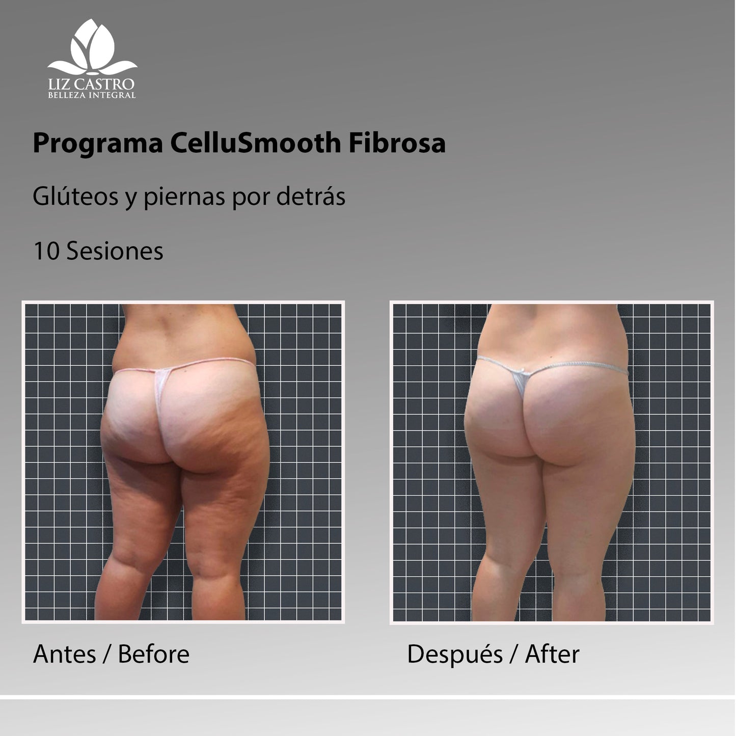 Programa anticelulítico para celulitis fibrosa