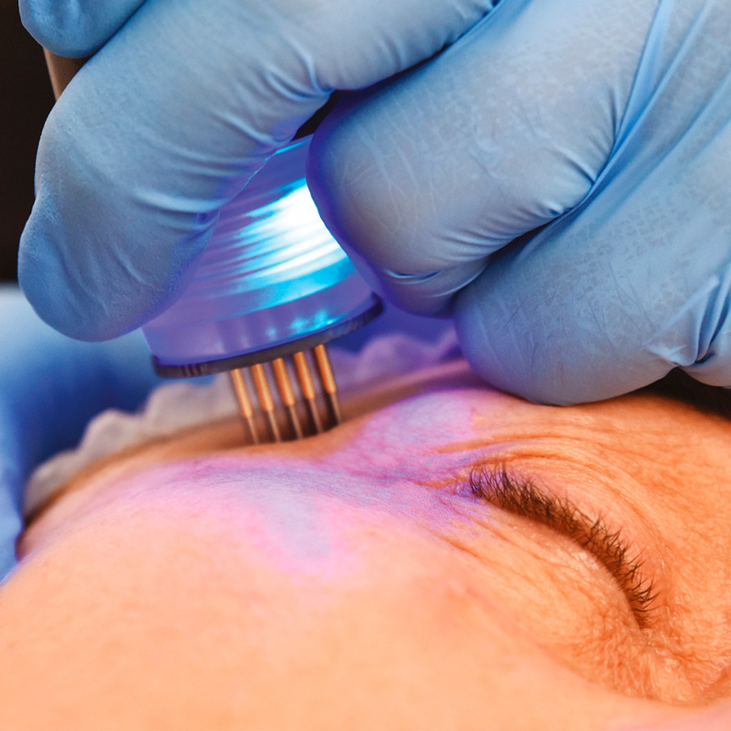 RF Fraccionada Pulsada (45–60 min)